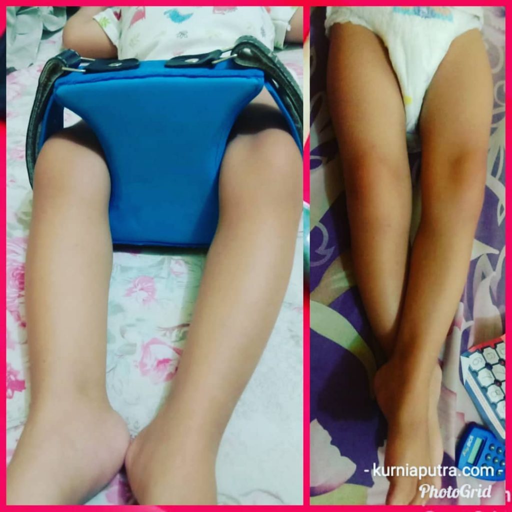 Knee Separator