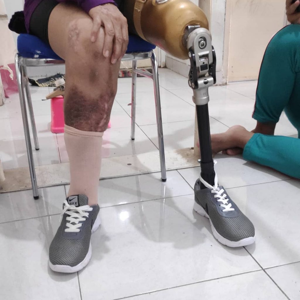 jual kaki palsu bekasi