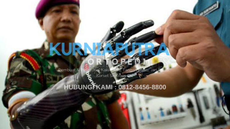 harga tangan palsu bionic