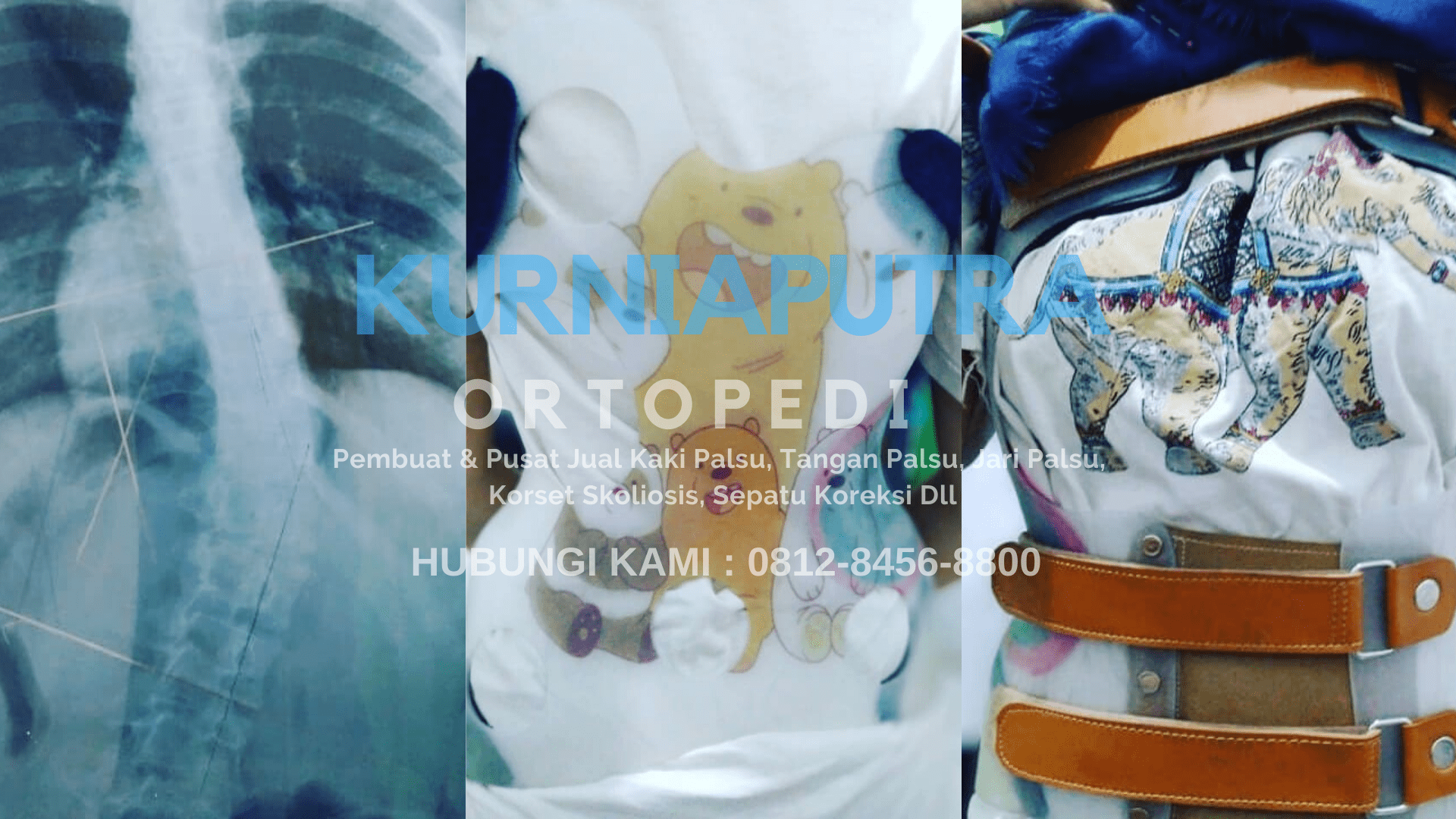jual korset skoliosis jakarta barat