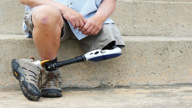 amputasi kaki adalah amputasi kaki adalah