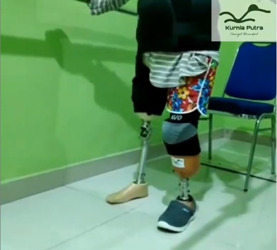 biaya amputasi kaki biaya amputasi kaki