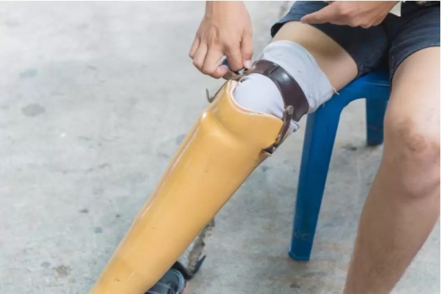 Amputasi Kaki Karena Diabetes Amputasi Kaki Karena Diabetes