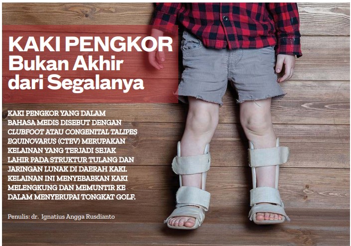 penyebab kaki pengkor dan cara pencegahan nya penyebab kaki pengkor
