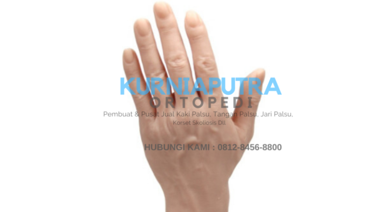 tangan amputasi diabetes