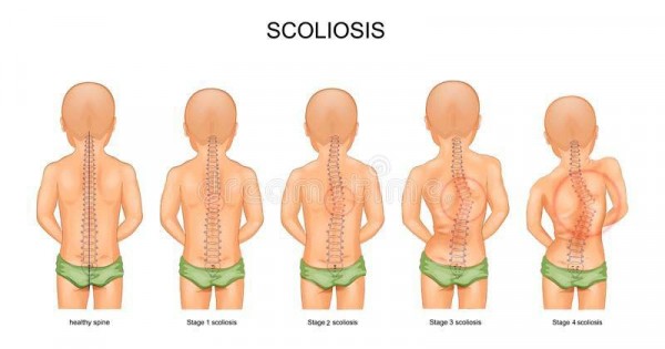 skoliosis pada bayi skoliosis pada bayi
