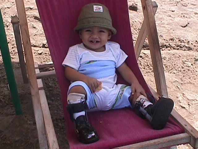 Apakah kaki Pengkor Bisa Sembuh