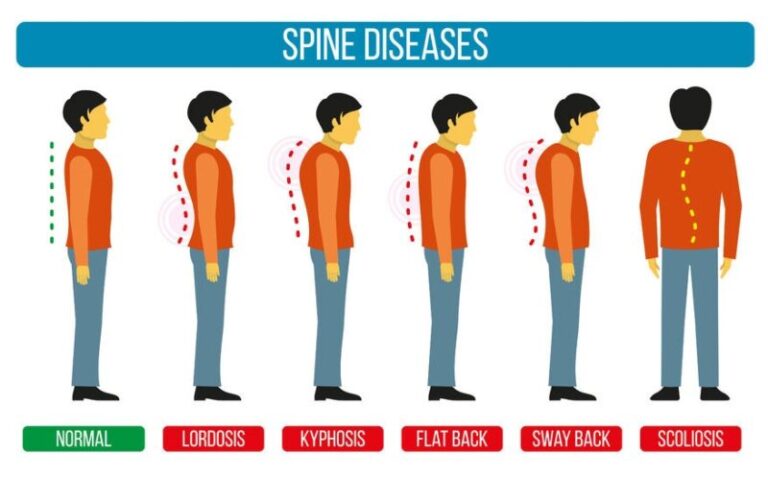 Scoliosis Quote : Kata Kata Motivasi Untuk Penderita Skoliosis