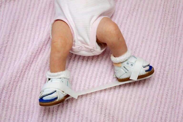 Sepatu kaki pengkor