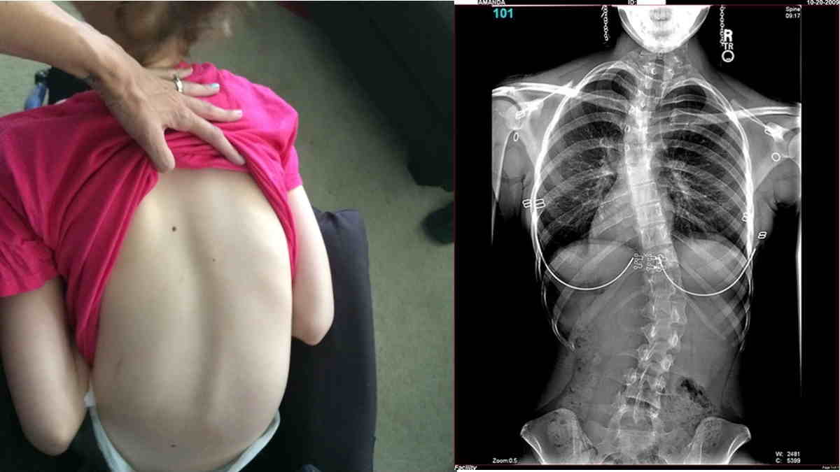 Skoliosis Degeneratif Skoliosis Degeneratif