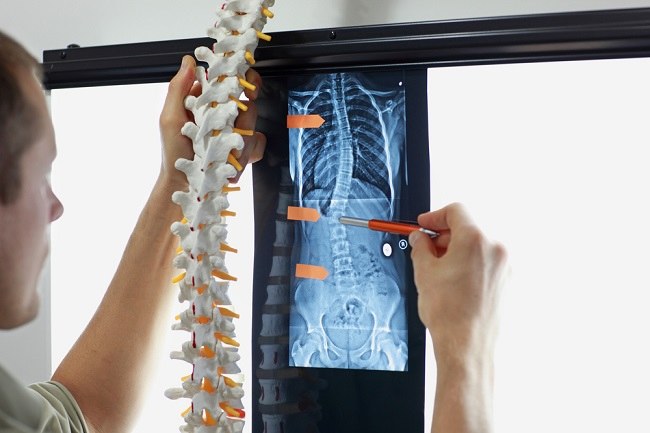 Pengertian Skoliosis vertebra lumbalis adalah