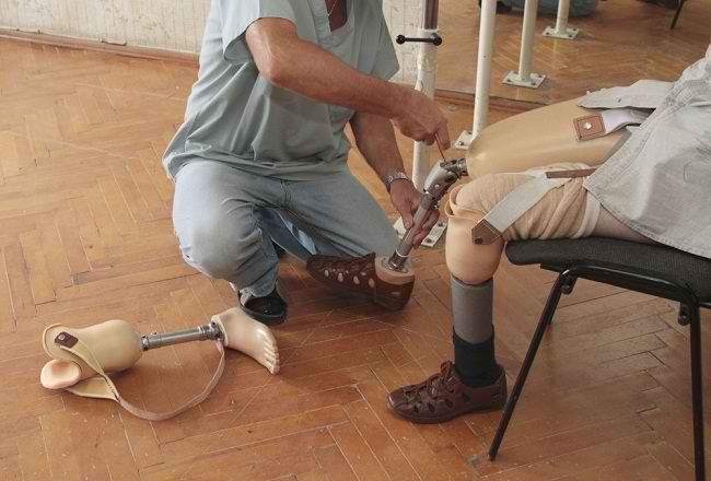 keuntungan menggunakan kaki palsu
